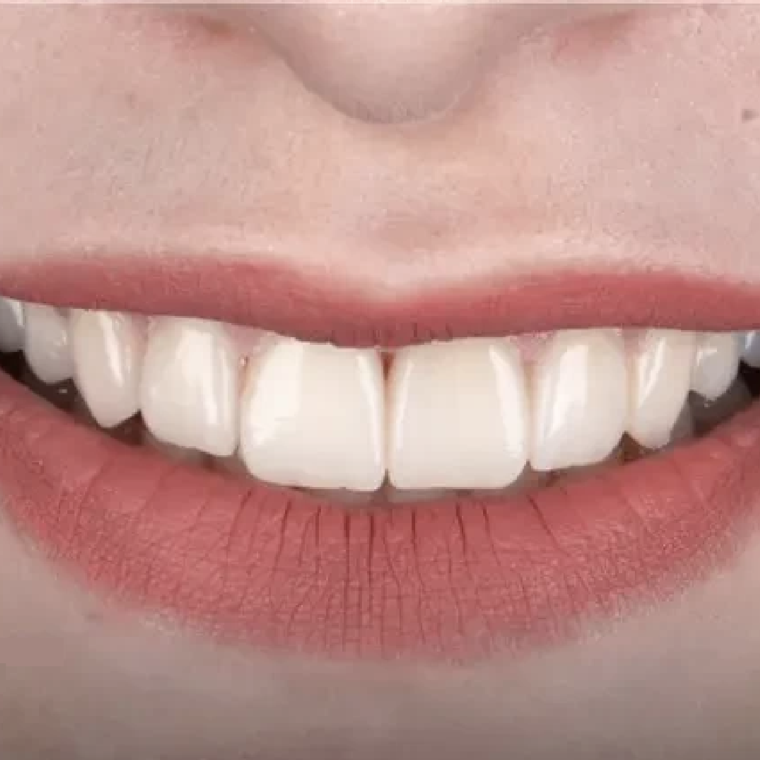 ٠١اللثة بعد