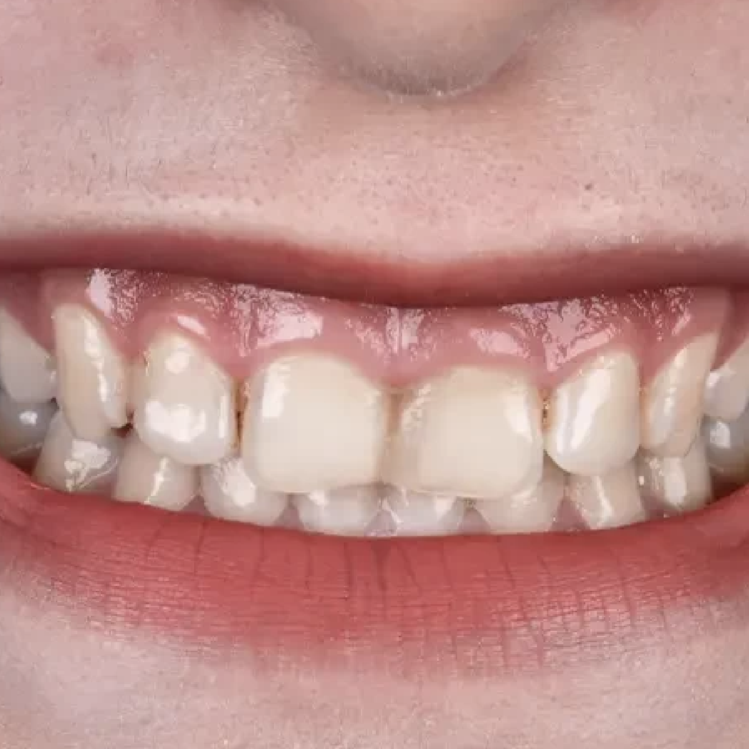 ٠١اللثة قبل